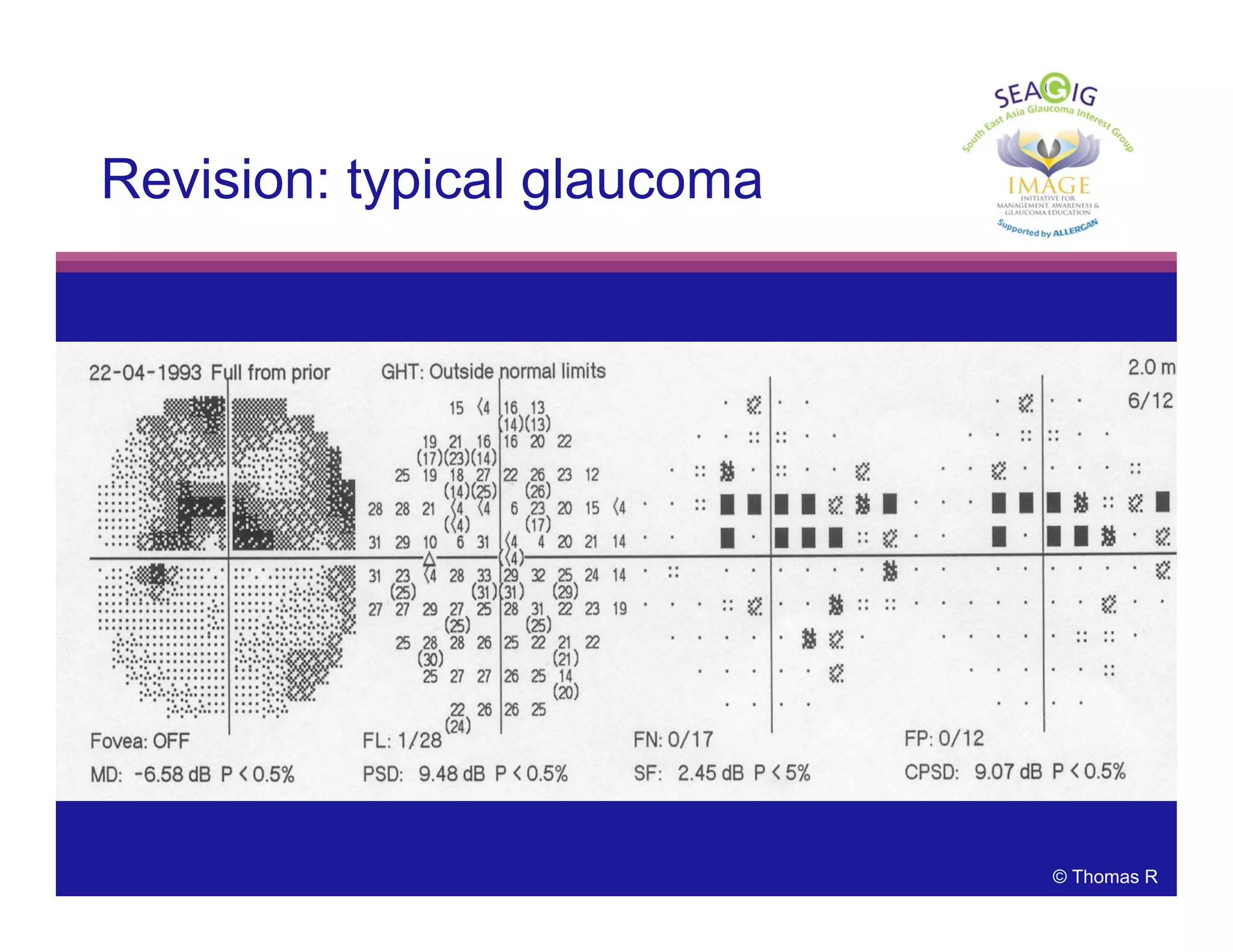 © Thomas R
Revision: typical glaucoma
 