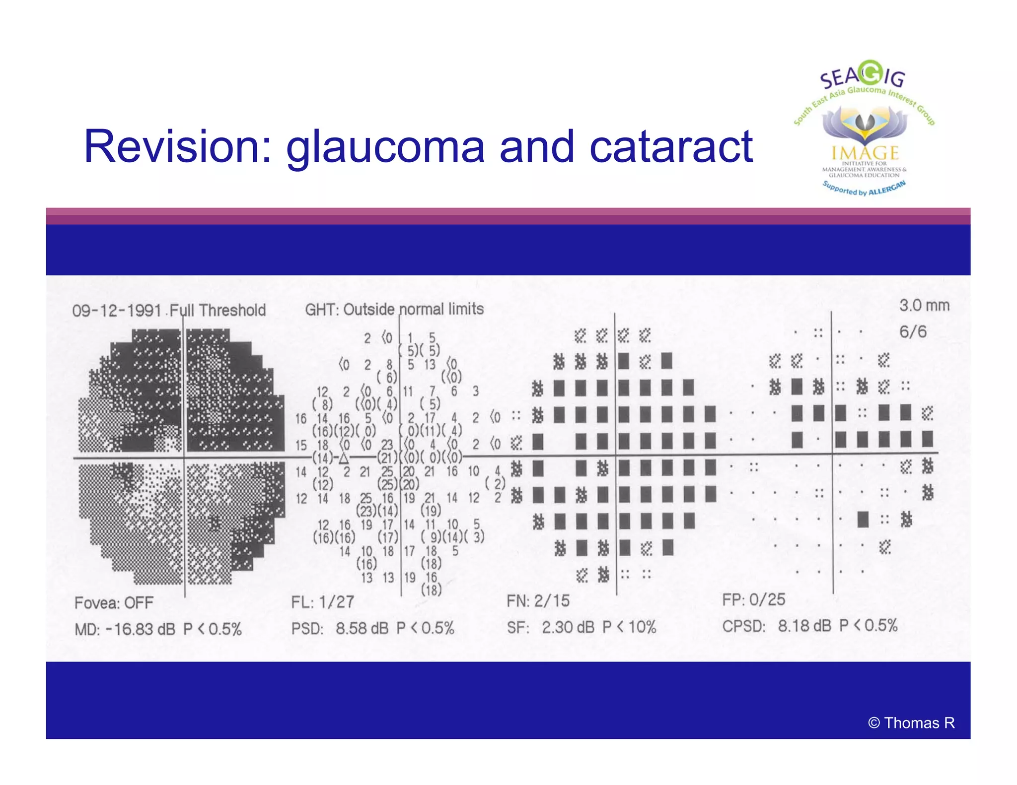 © Thomas R
Revision: glaucoma and cataract
 