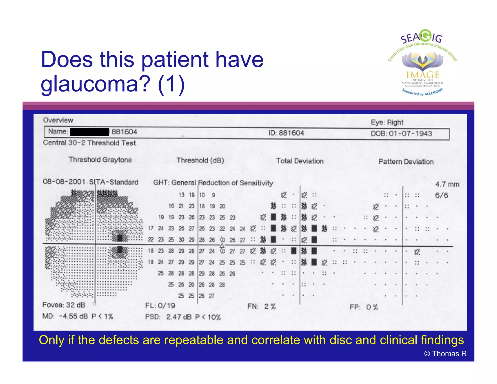 © Thomas R
Does this patient have
glaucoma? (1)
Only if the defects are repeatable and correlate with disc and clinical findings
 