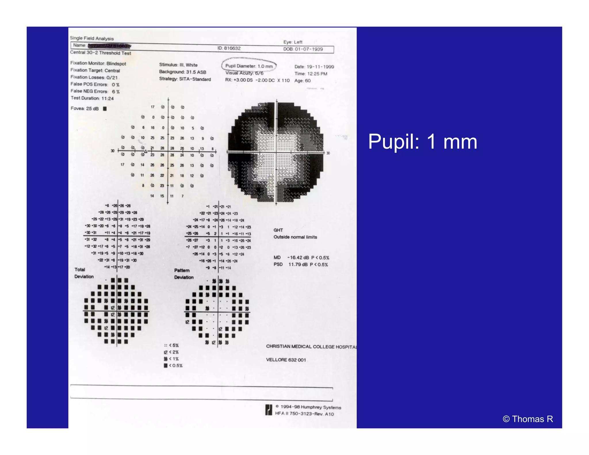 Pupil: 1 mm
© Thomas R
 