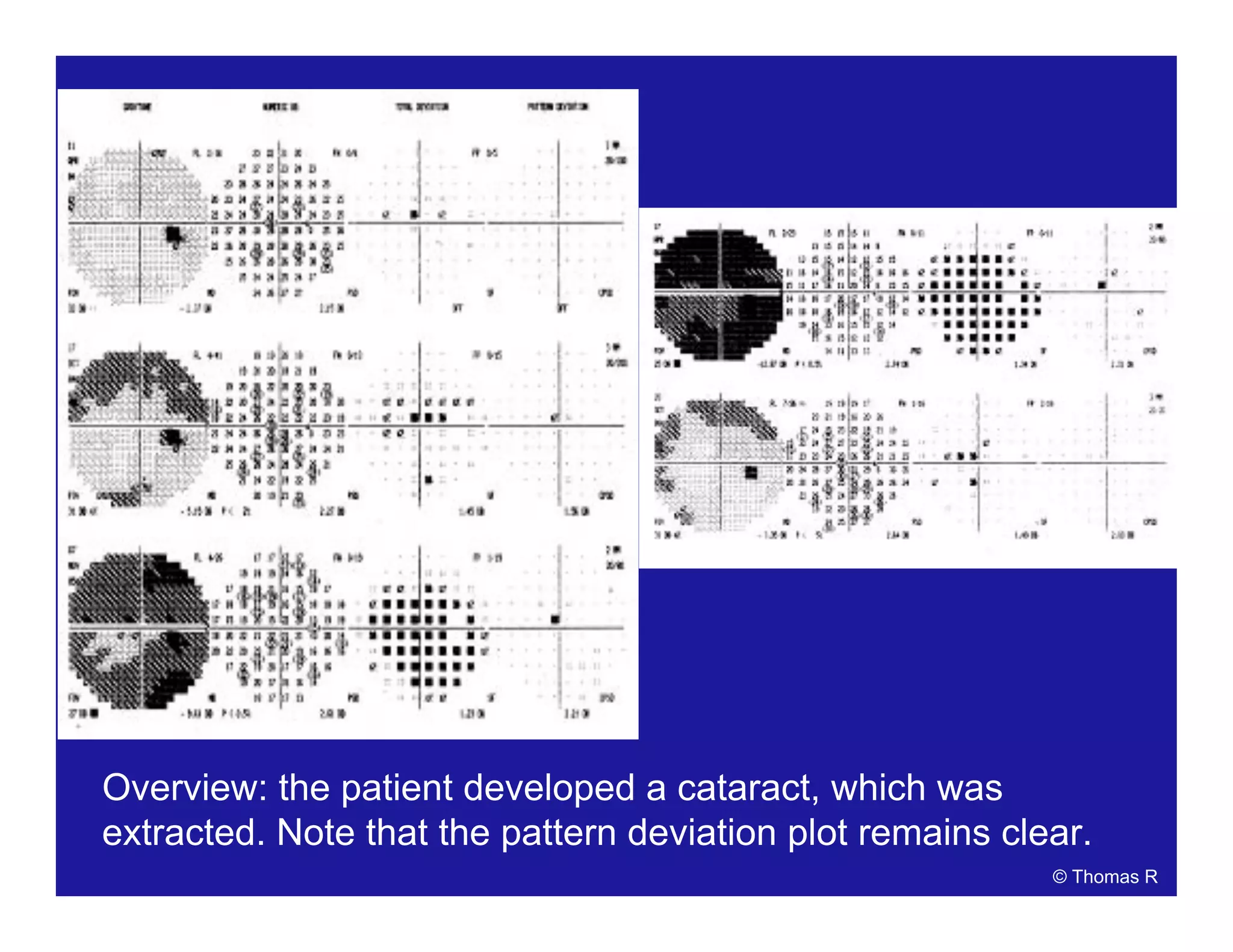 Overview: the patient developed a cataract, which was
extracted. Note that the pattern deviation plot remains clear.
© Thomas R
 