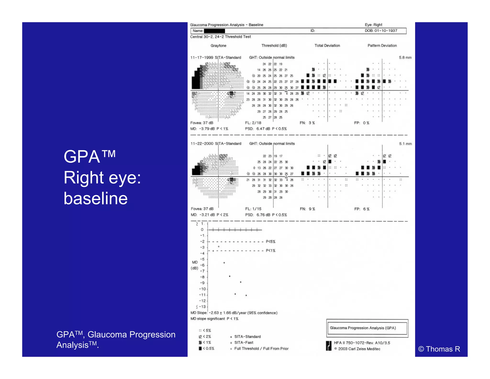 GPA™
Right eye:
baseline
© Thomas R
GPATM, Glaucoma Progression
AnalysisTM.
 
