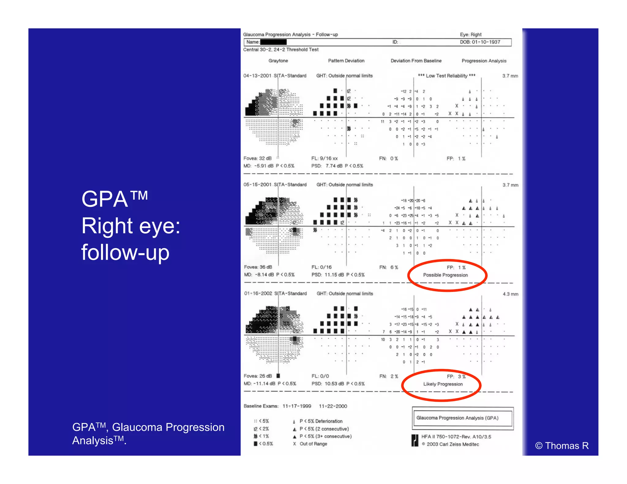 GPA™
Right eye:
follow-up
© Thomas R
GPATM, Glaucoma Progression
AnalysisTM.
 