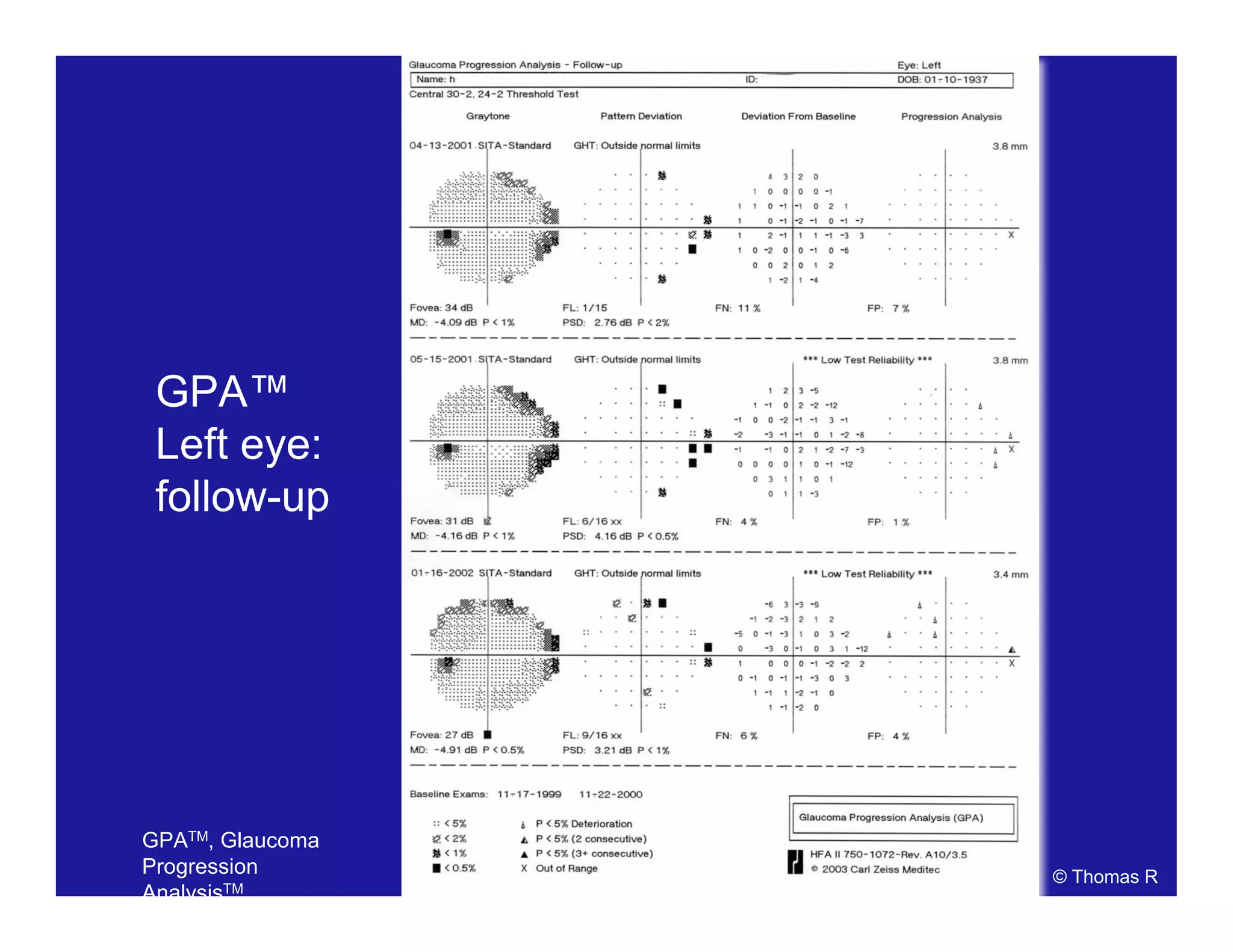 GPA™
Left eye:
follow-up
© Thomas R
GPATM, Glaucoma
Progression
AnalysisTM.
 