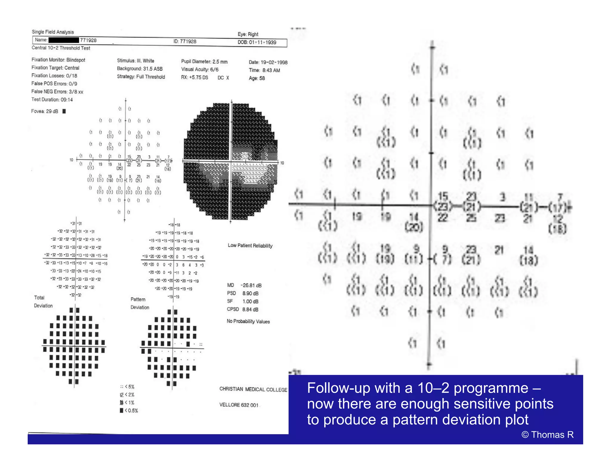 Follow-up with a 10–2 programme –
now there are enough sensitive points
to produce a pattern deviation plot
© Thomas R
 