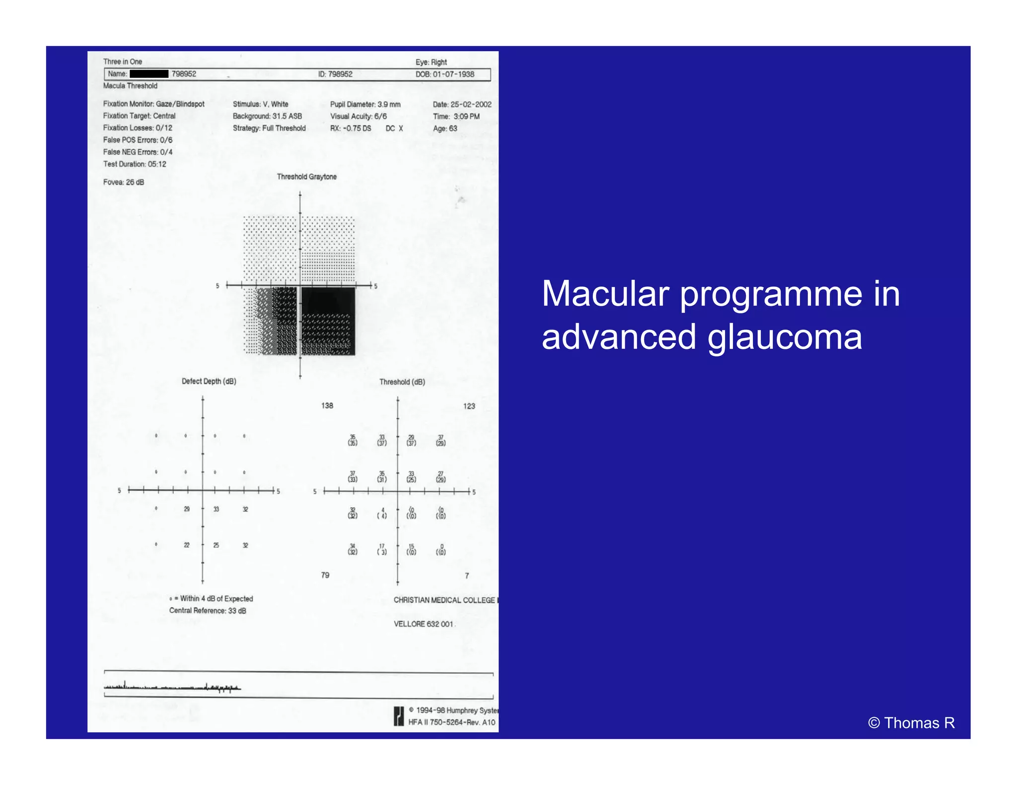 Macular programme in
advanced glaucoma
© Thomas R
 