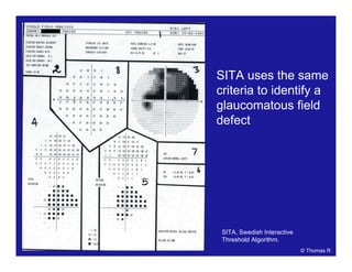 SITA uses the same
criteria to identify a
glaucomatous field
defect
© Thomas R
SITA, Swedish Interactive
Threshold Algorithm.
 