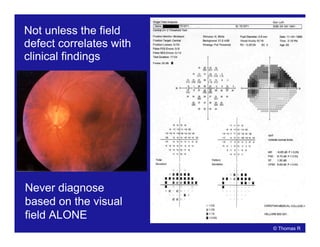 Not unless the field
defect correlates with
clinical findings
Never diagnose
based on the visual
field ALONE
© Thomas R
 