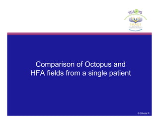 Comparison of Octopus and
HFA fields from a single patient
© Sihota R
 