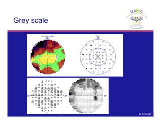 © Sihota R
Grey scale
 