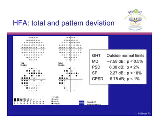 © Thomas R© Sihota R
GHT Outside normal limits
MD –7.58 dB; p < 0.5%
PSD 6.30 dB; p < 2%
SF 2.27 dB; p < 10%
CPSD 5.75 dB; p < 1%
HFA: total and pattern deviation
 
