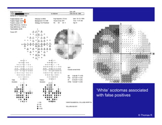‘White’ scotomas associated
with false positives
© Thomas R
 
