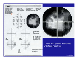 ‘Clover leaf’ pattern associated
with false negatives
© Thomas R
 
