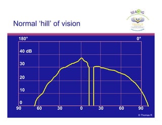 © Thomas R
180° 0°
40 dB
0
30
20
10
90 60 30 0 30 60 90
Normal ‘hill’ of vision
 