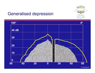 © Thomas R
180° 0°
40 dB
0
30
20
10
90 60 30 0 30 60 90
Generalised depression
 