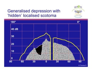 © Thomas R
180° 0°
40 dB
0
30
20
10
90 60 30 0 30 60 90
Generalised depression with
‘hidden’ localised scotoma
 
