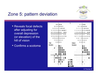© Thomas R
• Reveals focal defects
after adjusting for
overall depression
(or elevation) of the
hill of vision
• Confirms a scotoma
::
::
Zone 5: pattern deviation
 