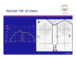 © Thomas R
Normal ‘hill’ of vision
 