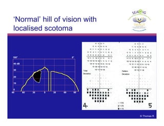 © Thomas R
‘Normal’ hill of vision with
localised scotoma
SEAGIG. Asia Pacific Glaucoma Guidelines. 2003–2004.
180° 0°
40 dB
0
30
20
10
90 60 30 0 30 60 90
‘Normal’ hill of vision with
localised scotoma
 