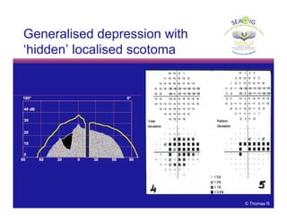© Thomas R
Generalised depression with
‘hidden’ localised scotoma
 
