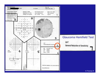 Glaucoma Hemifield Test
© Thomas R
 