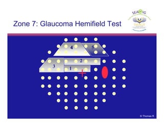© Thomas R
Zone 7: Glaucoma Hemifield Test
44 5
3
2
1
 
