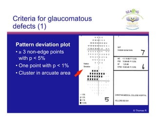 © Thomas R
Criteria for glaucomatous
defects (1)
Pattern deviation plot
• ≥ 3 non-edge points
with p < 5%
• One point with p < 1%
• Cluster in arcuate area
 