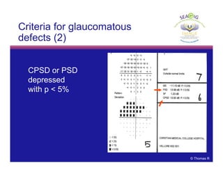 © Thomas R
Criteria for glaucomatous
defects (2)
CPSD or PSD
depressed
with p < 5%
 