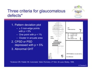 © Thomas R
Three criteria for glaucomatous
defects*
1. Pattern deviation plot
– ≥ 3 non-edge points
with p < 5%
– One point with p < 1%
– Cluster in arcuate area
2. CPSD or PSD
depressed with p < 5%
3. Abnormal GHT
*Anderson DR, Patella VM. Automated Static Perimetry. 2nd Edn. St Louis: Mosby, 1999.
 