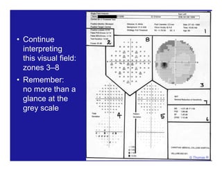 • Continue
interpreting
this visual field:
zones 3–8
• Remember:
no more than a
glance at the
grey scale
© Thomas R
 