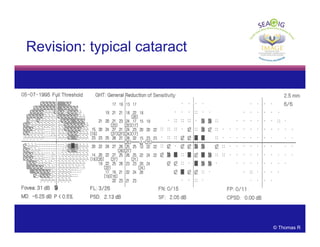 © Thomas R
Revision: typical cataract
 