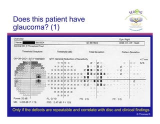 © Thomas R
Does this patient have
glaucoma? (1)
Only if the defects are repeatable and correlate with disc and clinical findings
 