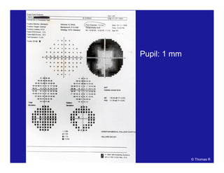 Pupil: 1 mm
© Thomas R
 