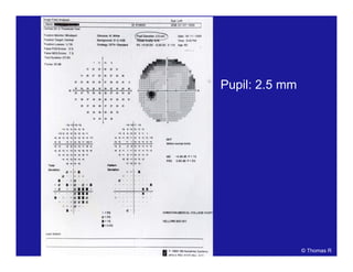 Pupil: 2.5 mm
© Thomas R
 