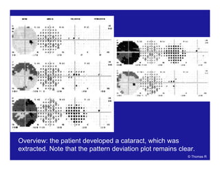 Overview: the patient developed a cataract, which was
extracted. Note that the pattern deviation plot remains clear.
© Thomas R
 