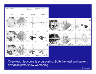 Overview: glaucoma is progressing. Both the total and pattern
deviation plots show worsening.
© Thomas R
 