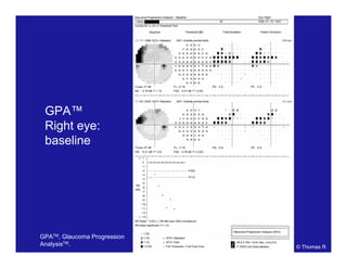 GPA™
Right eye:
baseline
© Thomas R
GPATM, Glaucoma Progression
AnalysisTM.
 