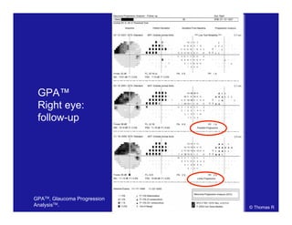GPA™
Right eye:
follow-up
© Thomas R
GPATM, Glaucoma Progression
AnalysisTM.
 