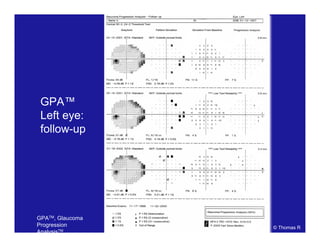 GPA™
Left eye:
follow-up
© Thomas R
GPATM, Glaucoma
Progression
AnalysisTM.
 