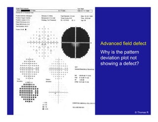 Advanced field defect
Why is the pattern
deviation plot not
showing a defect?
© Thomas R
 