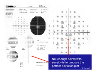 Not enough points with
sensitivity to produce the
pattern deviation plot
© Thomas R
 