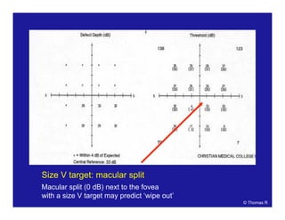 Size V target: macular split
Macular split (0 dB) next to the fovea
with a size V target may predict ‘wipe out’
© Thomas R
 