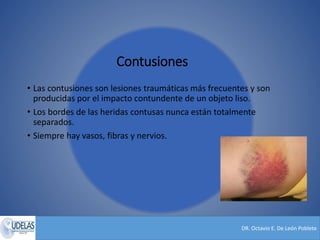 DR. Octavio E. De León Poblete
Contusiones
• Las contusiones son lesiones traumáticas más frecuentes y son
producidas por el impacto contundente de un objeto liso.
• Los bordes de las heridas contusas nunca están totalmente
separados.
• Siempre hay vasos, fibras y nervios.
 