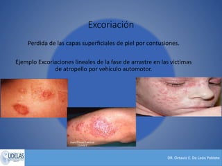 DR. Octavio E. De León Poblete
Excoriación
Perdida de las capas superficiales de piel por contusiones.
Ejemplo Excoriaciones lineales de la fase de arrastre en las victimas
de atropello por vehículo automotor.
 