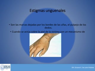 DR. Octavio E. De León Poblete
Estigmas unguenales
• Son las marcas dejadas por los bordes de las uñas, el pulpejo de los
dedos.
• Cuando se actúa sobre la piel de la victima con un mecanismo de
presión.
 