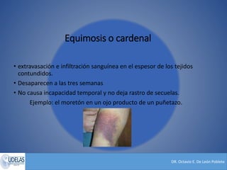 DR. Octavio E. De León Poblete
Equimosis o cardenal
• extravasación e infiltración sanguínea en el espesor de los tejidos
contundidos.
• Desaparecen a las tres semanas
• No causa incapacidad temporal y no deja rastro de secuelas.
Ejemplo: el moretón en un ojo producto de un puñetazo.
 