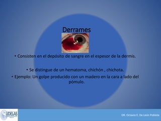 DR. Octavio E. De León Poblete
Derrames
• Consisten en el depósito de sangre en el espesor de la dermis.
• Se distingue de un hematoma, chichón , chichota.
• Ejemplo: Un golpe producido con un madero en la cara a lado del
pómulo.
 
