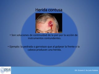 DR. Octavio E. De León Poblete
Herida contusa
• Son soluciones de continuidad de la piel por la acción de
instrumentos contundentes.
• Ejemplo: la pedrada o garrotazo que al golpear la frente o la
cabeza producen una herida.
 