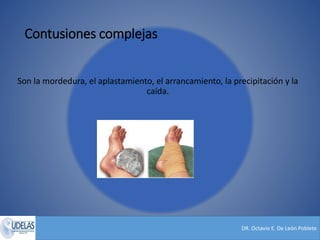 DR. Octavio E. De León Poblete
Contusiones complejas
Son la mordedura, el aplastamiento, el arrancamiento, la precipitación y la
caída.
 