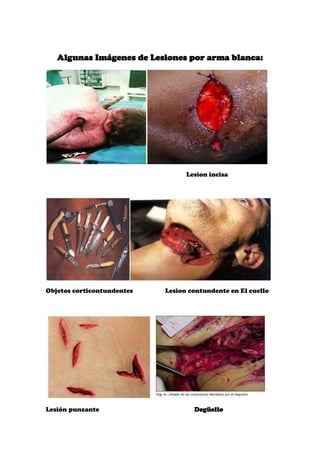 Algunas Imágenes de Lesiones por arma blanca:




                                  Lesion incisa




Objetos corticontundentes   Lesion contundente en El cuello




Lesión punzante                     Degüello
 